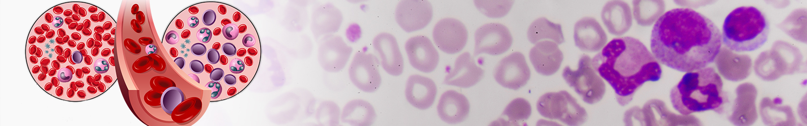 lymphomas in chennai