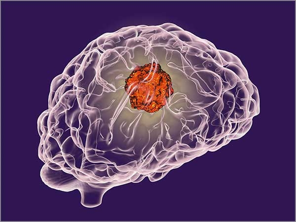 brain cancer treatment chennai