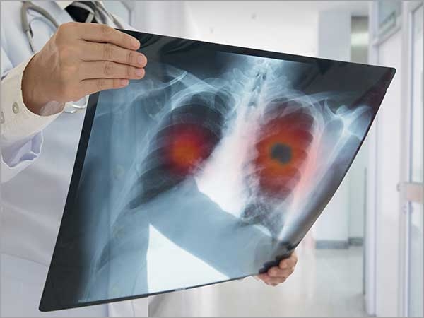 lung cancer in chennai