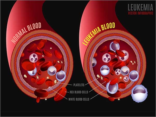 leukemias in chennai