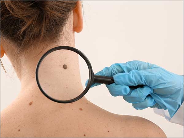 skin cancer treatment in chennai