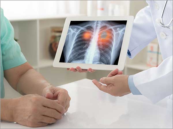 lung cancer treatment in chennai