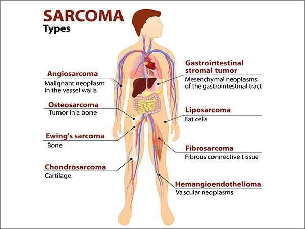 sarcomas in chennai