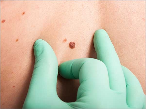 skin cancer in chennai